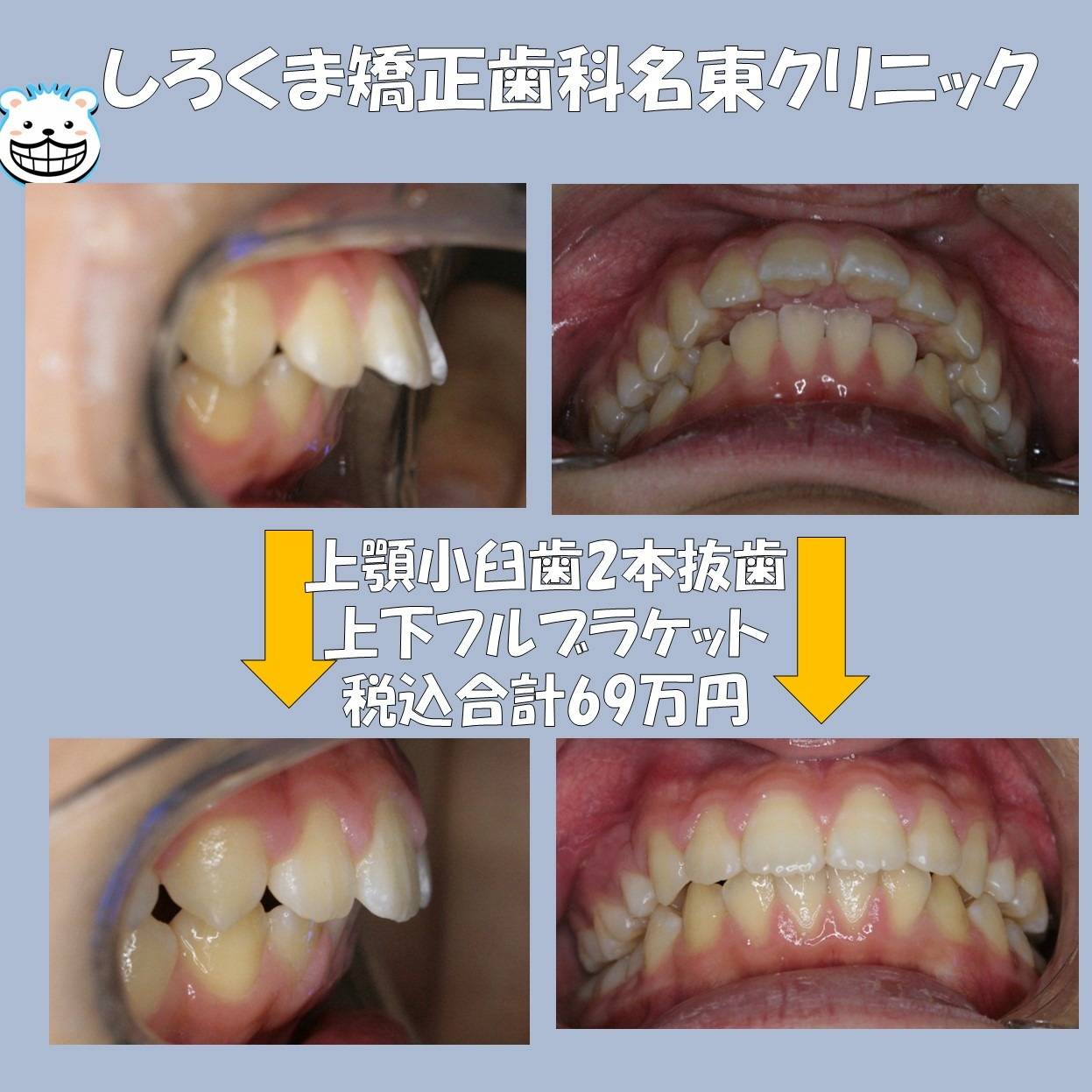上顎２本抜歯ワイヤー矯正症例紹介✨