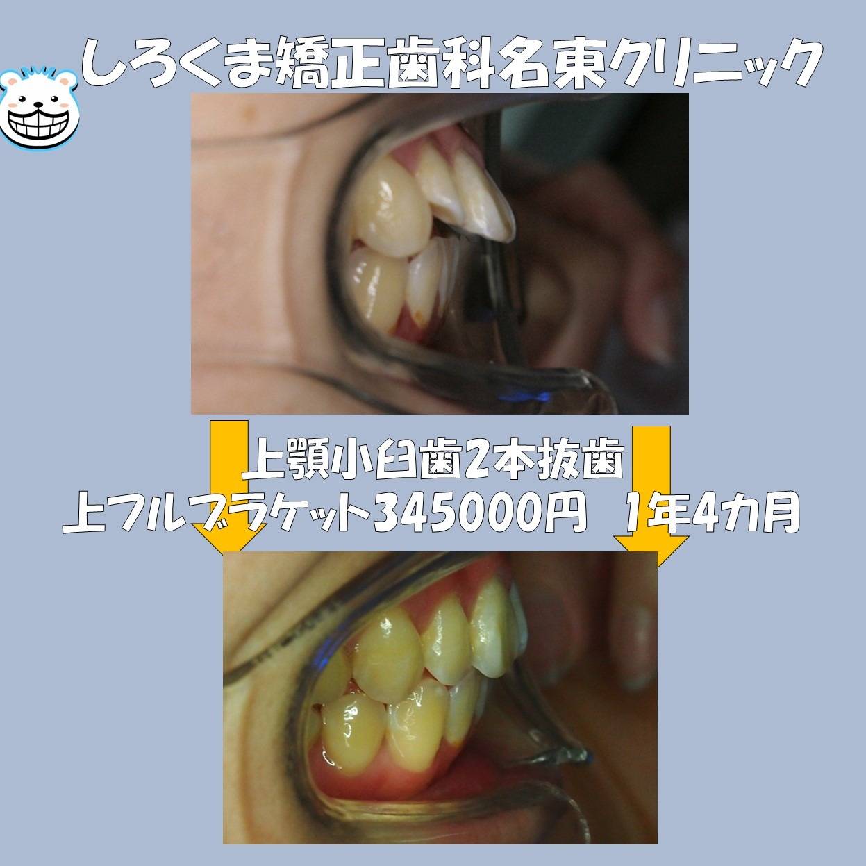 症例紹介💪🔥上顎のみのフルブラケット❕